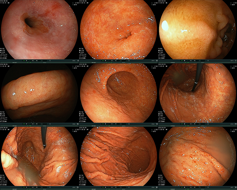 胃内視鏡検査(胃カメラ) 