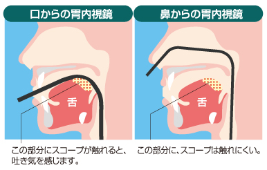 経鼻内視鏡について