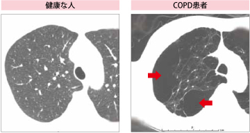 ＣＯＰＤの病態