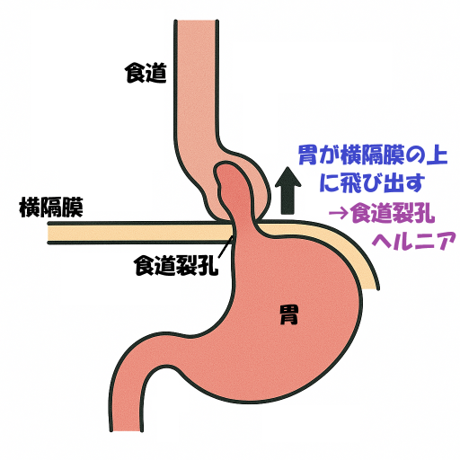 食道裂孔ヘルニア