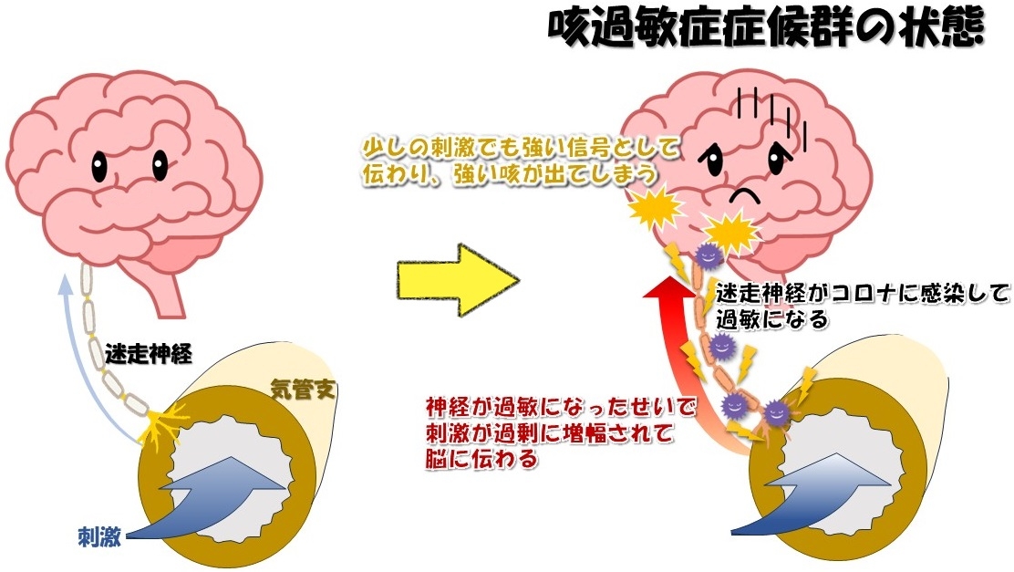 咳過敏症症候群