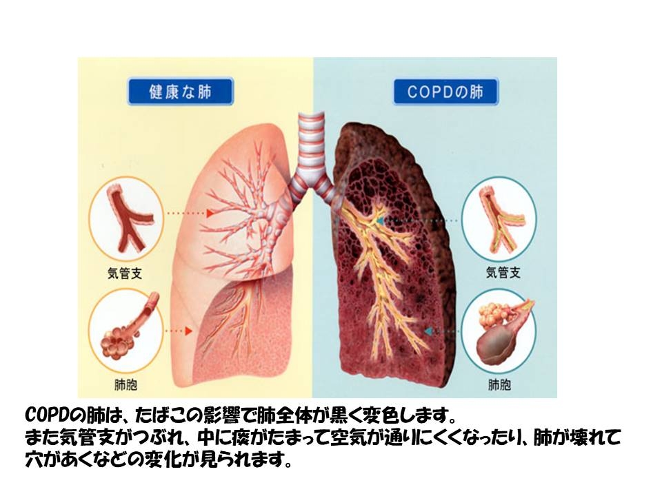 COPD