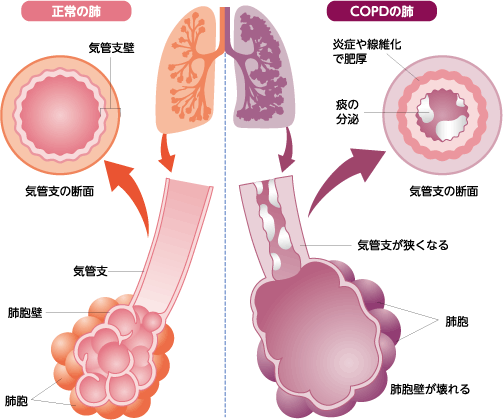 ＣＯＰＤの病態