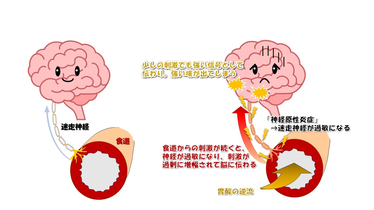逆流性食道炎