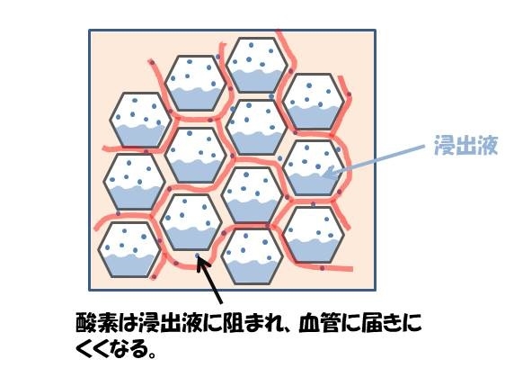 細菌性肺炎