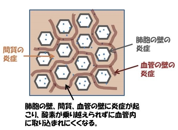 治る 肺炎 質 間 性