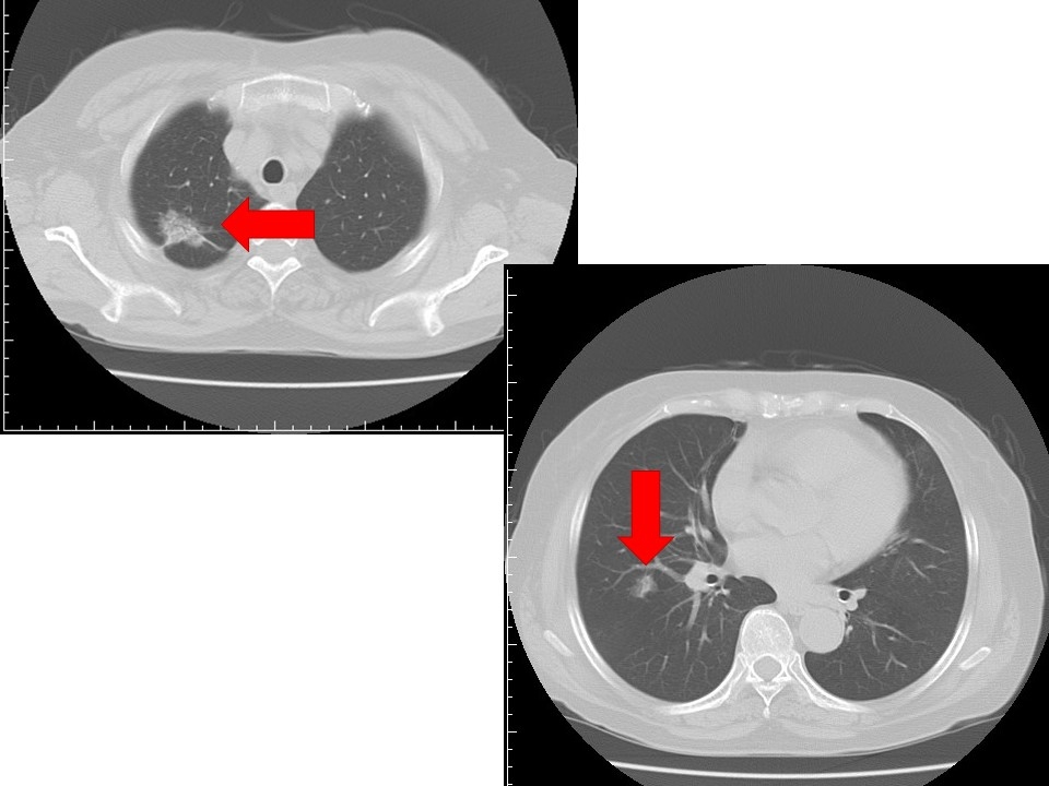 肺がん胸部CT