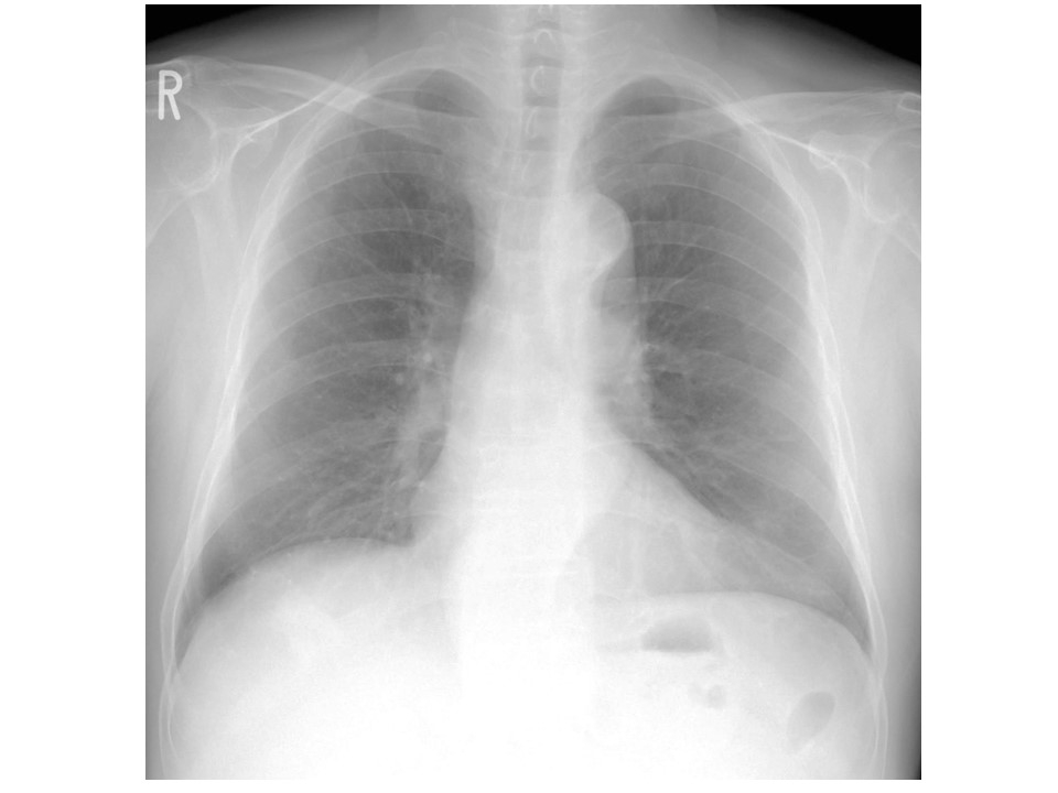 胸部レントゲン