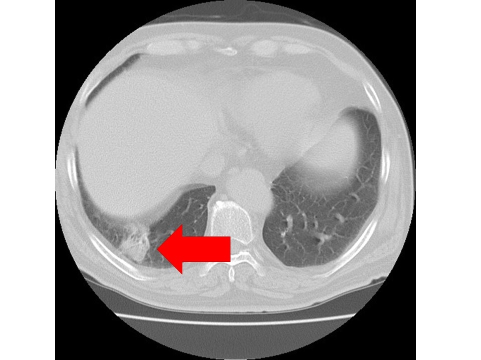 胸部CT肺がん
