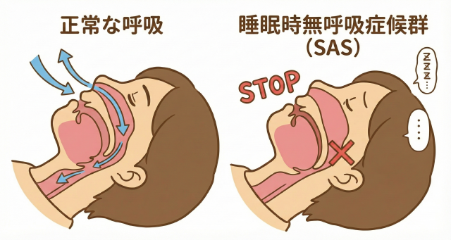 睡眠時無呼吸症候群