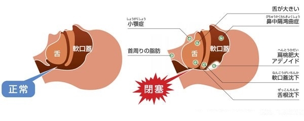 アレルゲン：アレルギーの原因