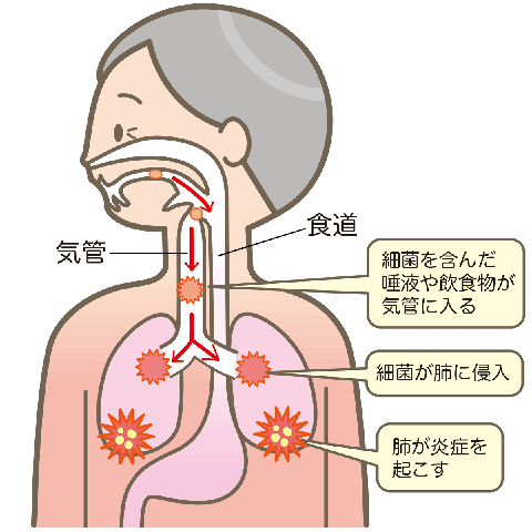 誤嚥性肺炎