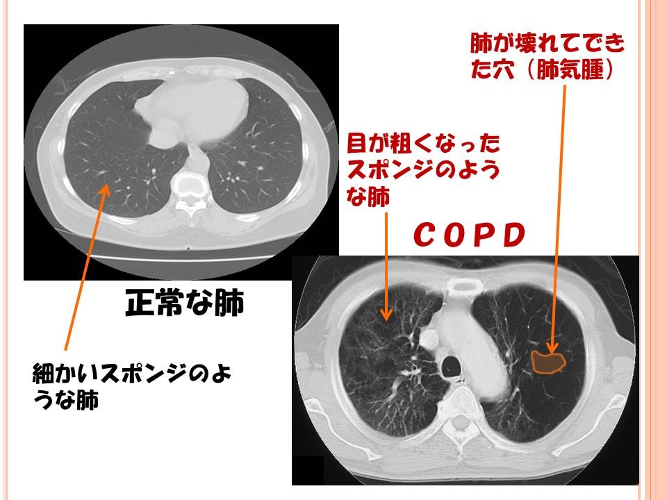 肺気腫 慢性 肺気腫