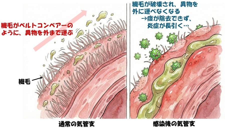 喘息とインフルエンザ
