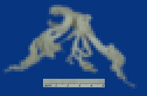 粘液栓