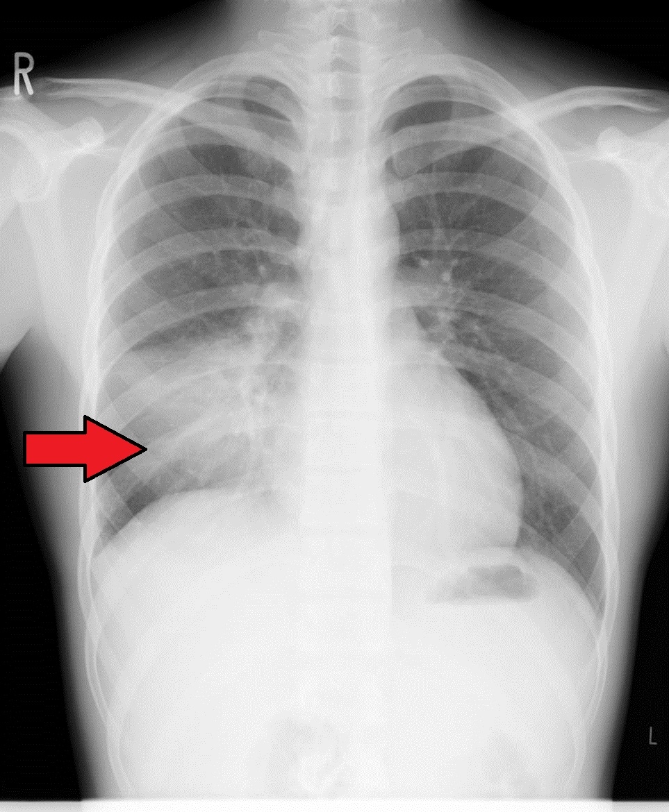 copd 肺気腫 慢性気管支炎